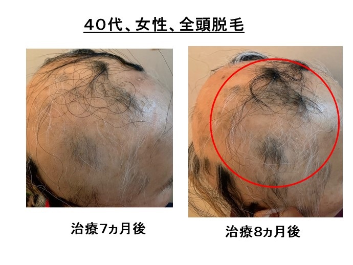 汎発性脱毛　病院